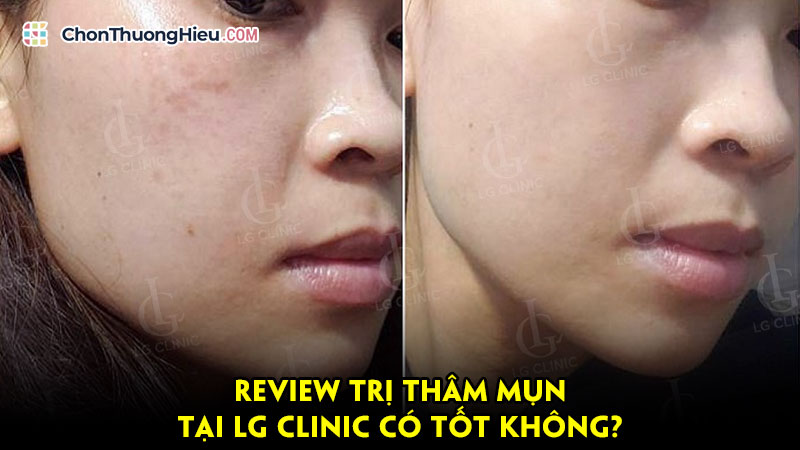 Review-tri-tham-mun-tai-lg-clinic-co-tot-khong-chonthuonghieu