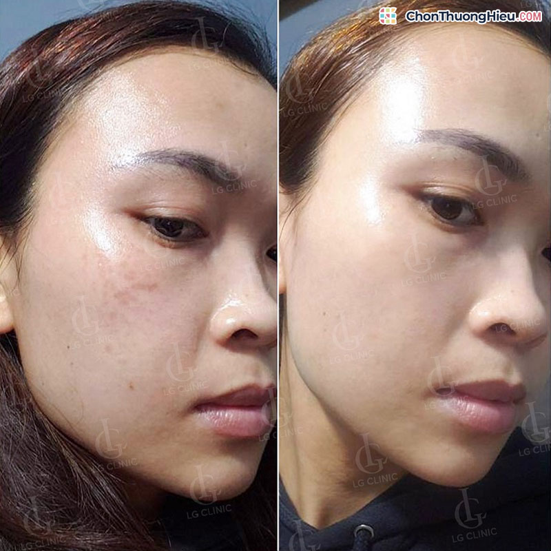 Trai-nghiem-quy-trinh-xoa-tham-tai-lg-clinic-voi-cong-nghe-deep-l-picosure-chonthuonghieu