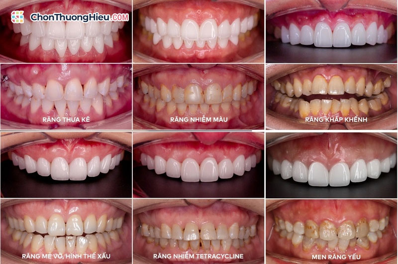 Nha khoa Đông Nam giải đáp: Bọc răng sứ có đau không và quy trình nhẹ nhàng Boc-rang-su-la-gi-va-co-dau-khong-chonthuonghieu